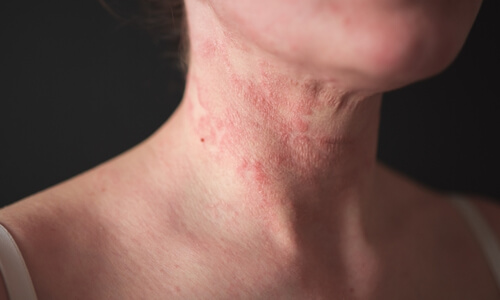 ClearSkin Blueprint: Conquering Eczema